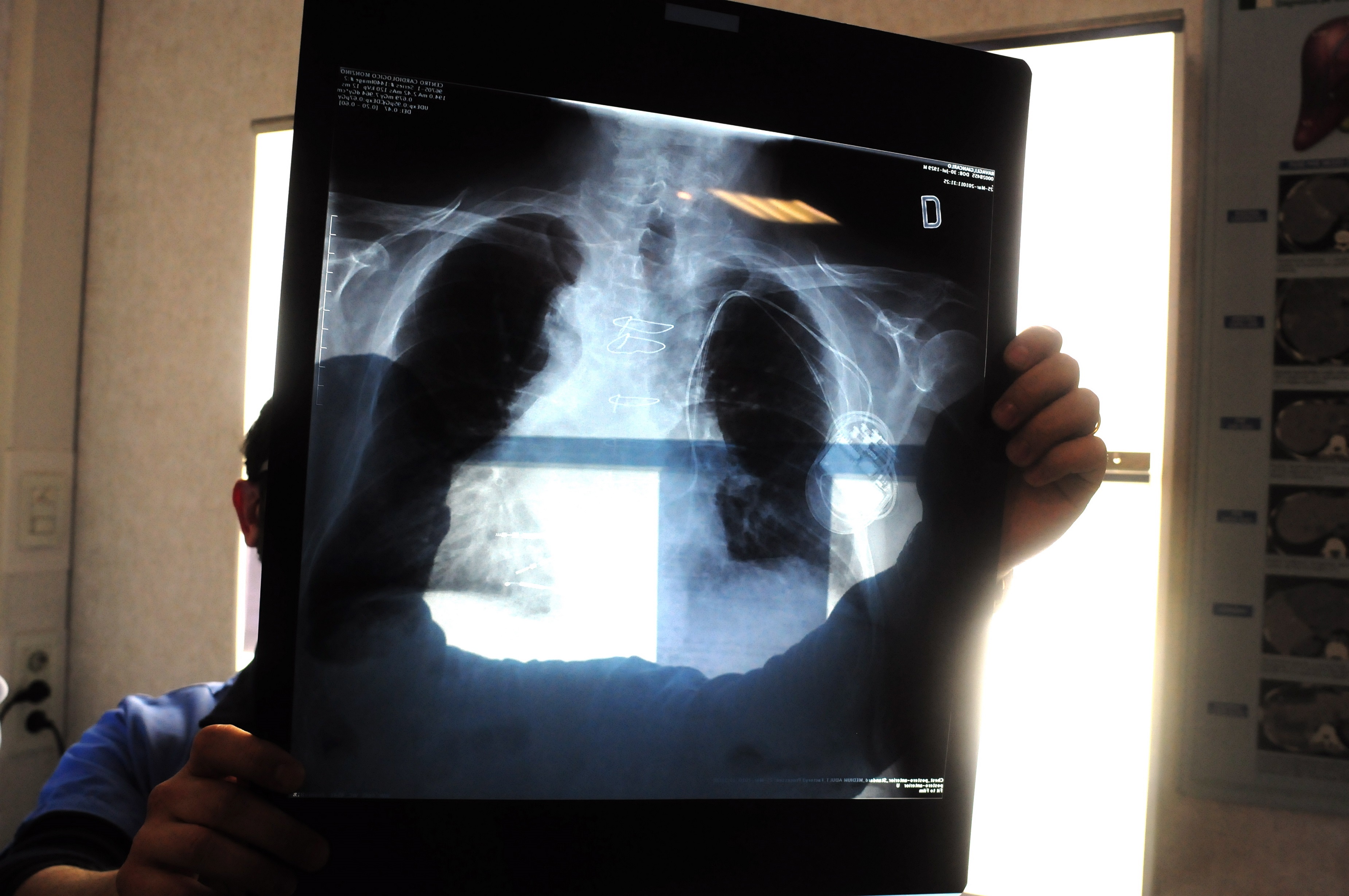 Staminali contro polmonite Covid, al via test su pazienti in Italia