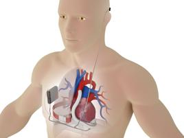 Dal Gemelli cuore artificiale 'wireless', primi pazienti al mondo