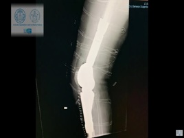 Siena, impiantata mega-protesi al ginocchio su paziente di 77 anni