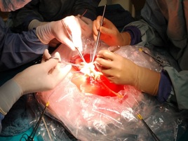 Tumori, a Padova trapiantato 20% fegato, organo rigenerato in 15 giorni