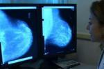 Tumore al seno, chemio evitabile in 70% casi iniziali con test genetico