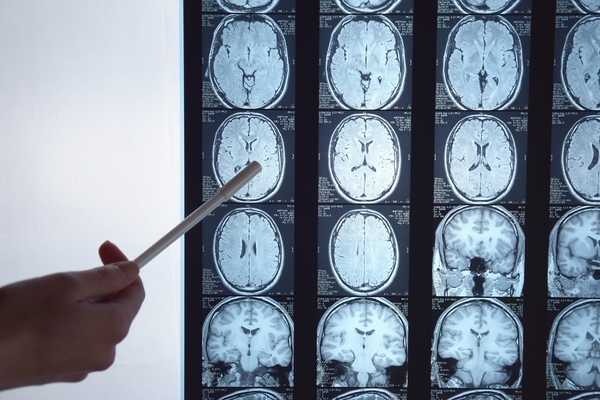 Covid: cos pu cambiare il cervello, studio su pazienti con sintomi persistenti