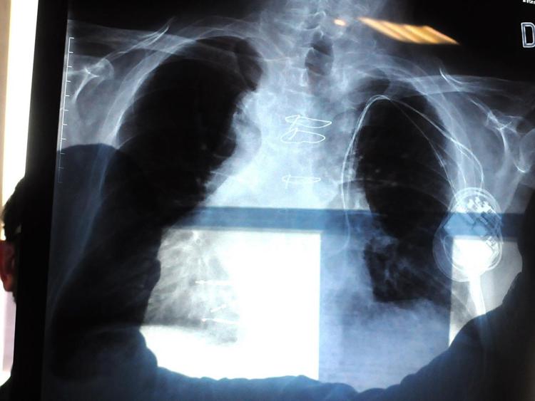 Identificato tallone d'Achille in 'motore' cancro polmoni, studio