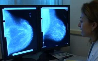 Scoperta italiana, successo cure cancro seno dipende da frammenti Rna